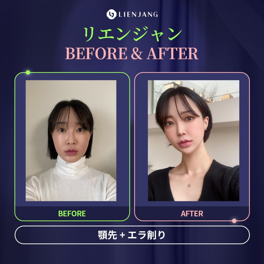 顎先 エラ 削り 整形 輪郭 輪郭3点 BEFORE AFTER ビフォー アフター