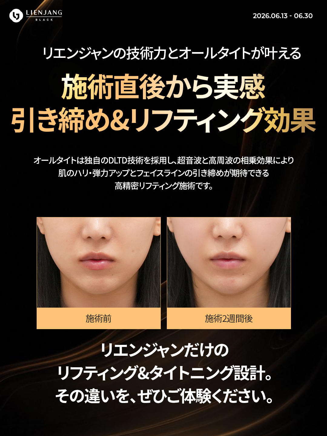 #韓国美容 #韓国皮膚科 #皮膚科 #韓国整形 #渡韓美容 #渡韓整形 #韓国旅行 #美肌 #美肌ケア #リフトアップ #アンチエイジング #ウルセラ #ウルセラピープライム #サーマクール #ポテンツァ #リジュラン #ジュベルック #エクソソーム #インモード #シュリンク #フィラー #唇フィラー #ボトックス #ララピール #水光肌 #オンダリフト #ソフウェーブ #リエンジャン #リエンジャン #KBEAUTY